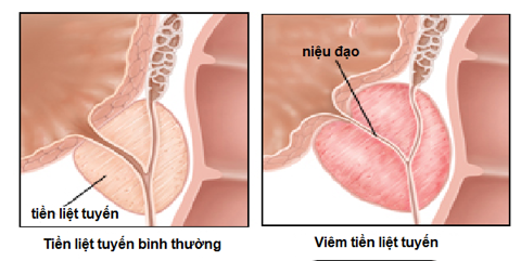 Viêm tiền liệt tuyến