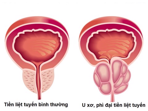 U xơ, phì đại tiền liệt tuyến