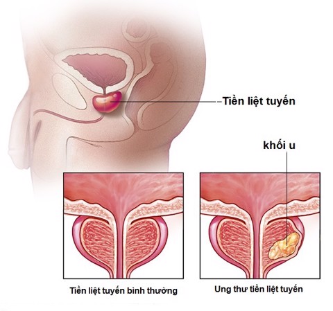 Ung thư tiền liệt tuyến
